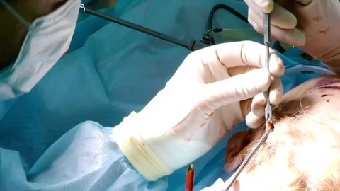 Using a small hole, the doctor enters the patient's head Stock Footage 72564985