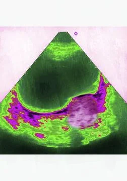  Uterine fibroma, sonography Gynecological ultrasound. Uterine fibroma - b... Stock Photos