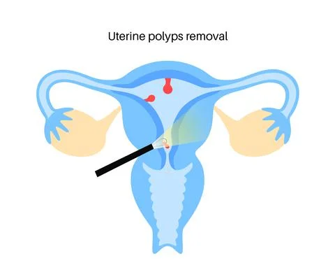 Uterine polyp endometrial Stock Illustration