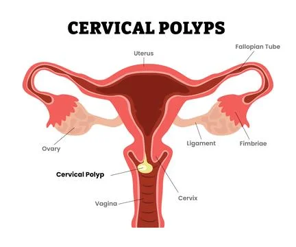 Uterine Polyps Endometrial Polyps, cervical polyps, female reproductive sys.. Stock Illustration