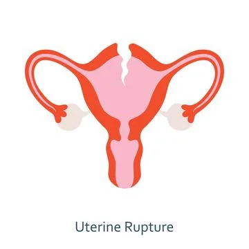 Uterine rupture Stock Illustration