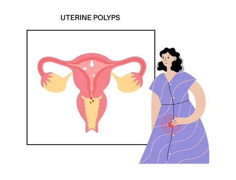 Uterus Polyps Disease Stock Illustration