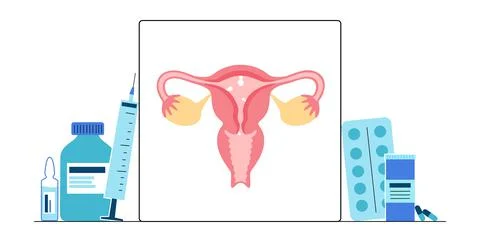 Uterus Polyps Stock Illustration