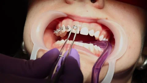 UV Light Curing Braces Adhesive in Dental Clinic   Stock Footage 312630001