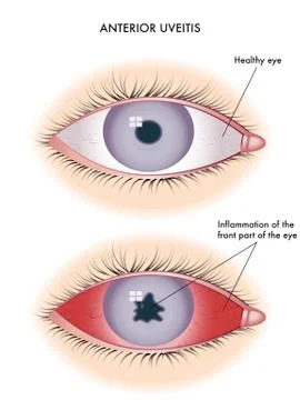 Uveitis Illustrazione stock
