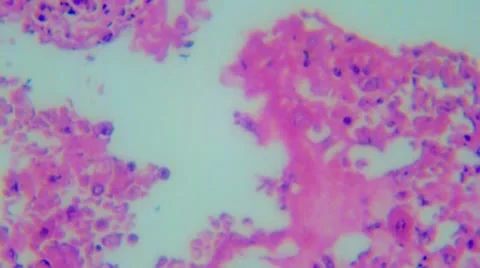 V22-1-Human Lung Tuberculosis Stock Footage 9703230