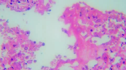 V22-3-Human Lung Tuberculosis Stock Footage 9703581