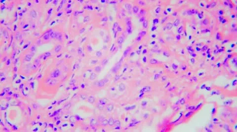 V22-4-Human Kidney Pyclonephritis Stock Footage 9703707