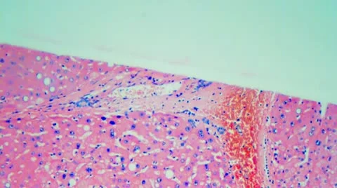 V22-9-Human Liver Cell Cancer Stock Footage 9698432