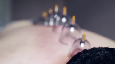 Vacuum cuppings on a man's back Stock Footage 67405927