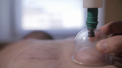 Vacuum massage therapy slow motion on the man Stock Footage 115256573
