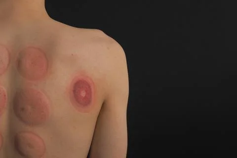 Vacuum therapy. A can of back massage. photo of the back after a vacuum massage. Stock Photos