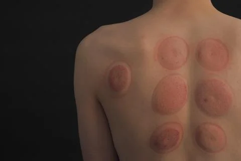 Vacuum therapy. A can of back massage. photo of the back after a vacuum massage. Stock Photos