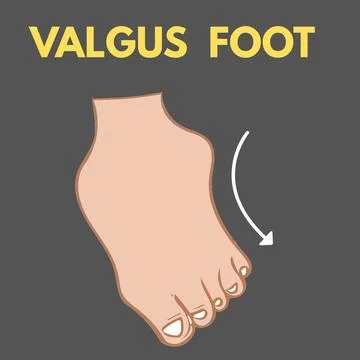 VALGUS  FOOT - 1 Stock Illustration