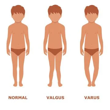 Valgus, varus knee Stock Illustration