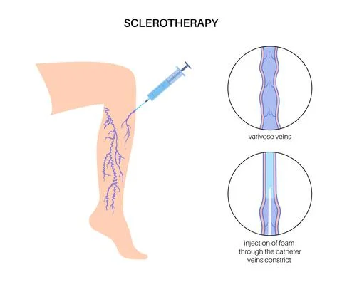 Varicose Injection procedure Stock Illustration