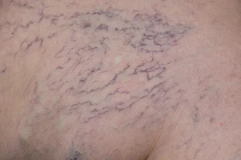 The varicose on legs Stock Photos