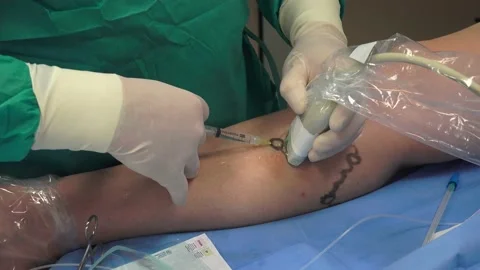 Varicose Spider Veins being treated in a hospital Stock Footage 239772971