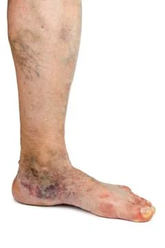 Varicose vein Stock Photos