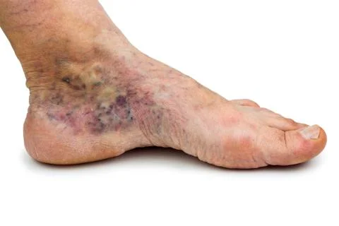 Varicose vein Stock Photos
