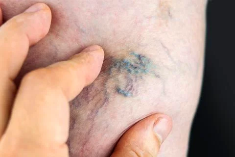 Varicose vein Foto stock