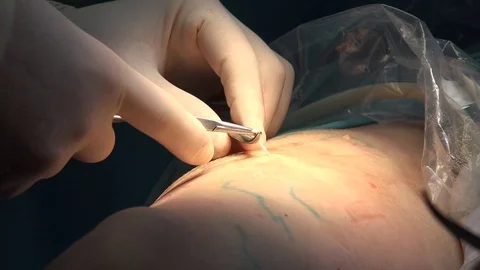 Varicose Veins 動画素材 100265941