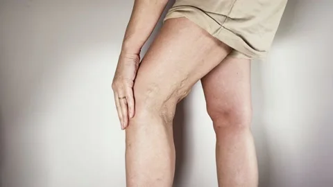 Varicose veins of the leg Stock Footage 229100340