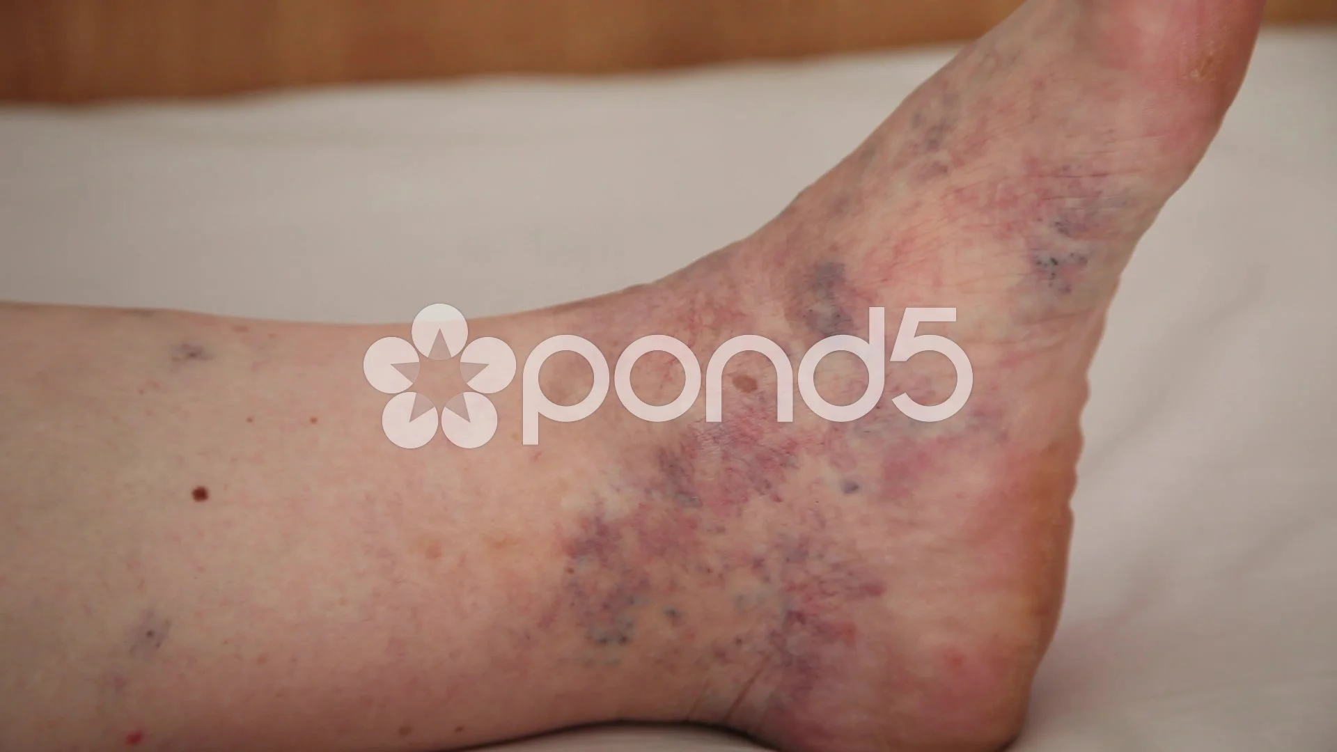 Varicose veins on leg old skin with edem, Stock Video