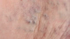 Varicose veins on leg old skin with edem, Stock Video