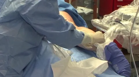 Varicose Veins operation Video stock 42393560