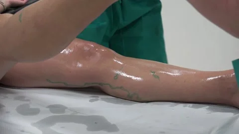 Varicose Veins on a patient Stock Footage 239618149