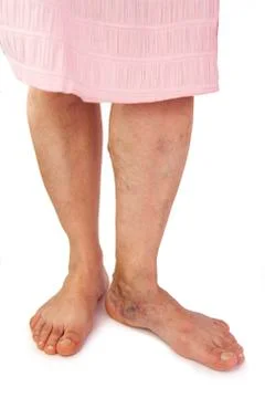 Varicose veins Stock Photos