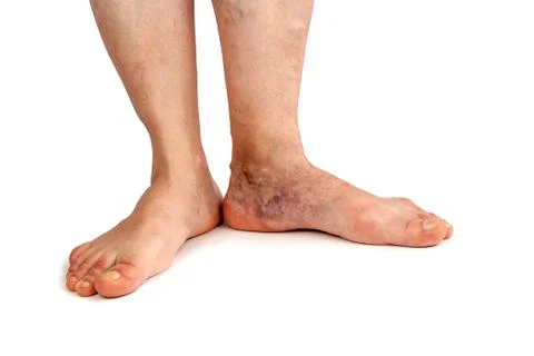 Varicose veins Stock Photos