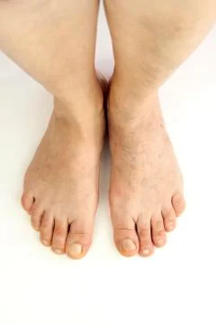 Varicose veins Foto stock