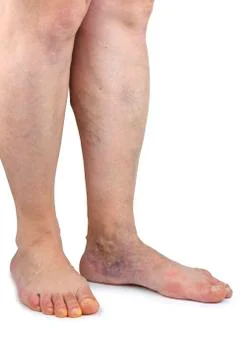 Varicose veins Stock Photos