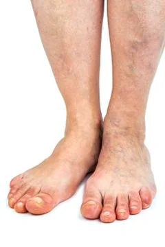 Varicose veins Stock Photos