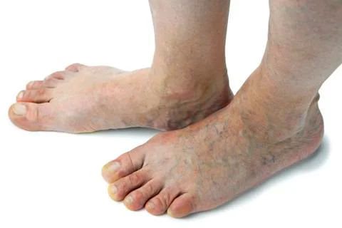 Varicose veins Stock Photos