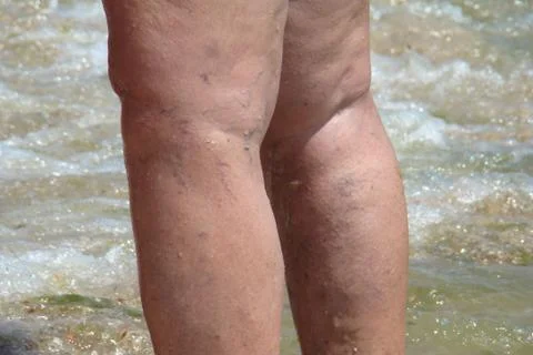 Varicose veins Stock Photos