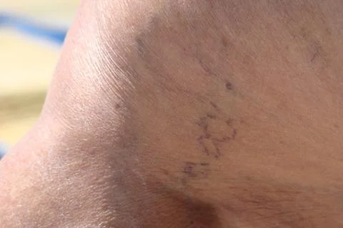 Varicose veins Stock Photos