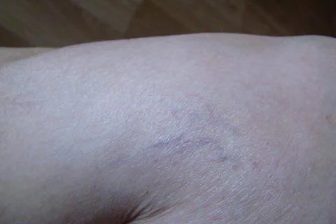 Varicose veins Stock Photos