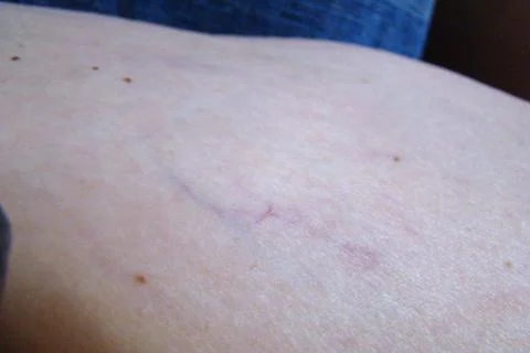 Varicose veins Stock Photos
