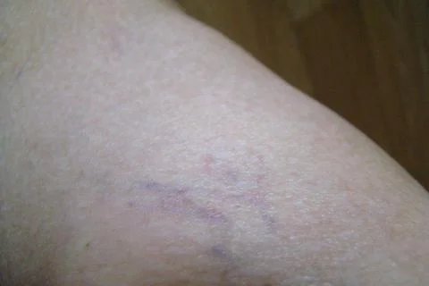 Varicose veins Stock Photos