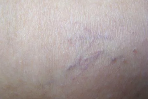 Varicose veins Stock Photos
