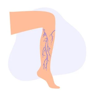 Varicose veins treatment Stock Illustration