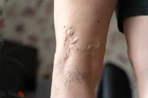 Varicose veins on woman legs indoors. Vascular health problem. Trombose on Stock Photos