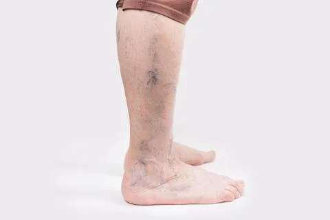 Varicosity. Close up side view of old feet of woman with vascular asterisks.  Stock Photos