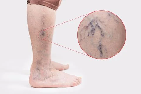 Varicosity. Close up side view of old feet of woman with vascular asterisks.  Stock Photos
