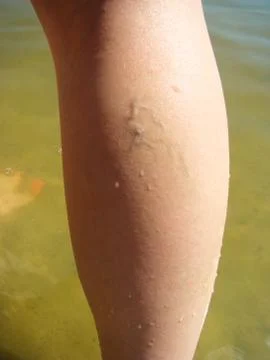 Varicosity Stock Photos