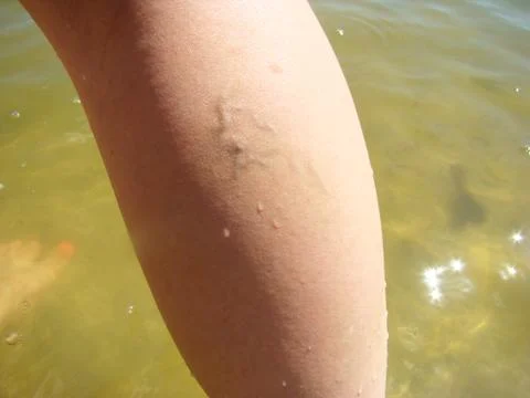 Varicosity Stock Photos