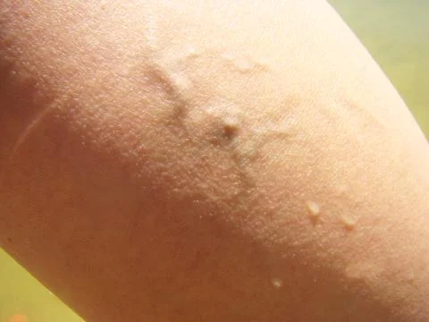 Varicosity Stock Photos